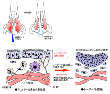 手術の実際 イラスト